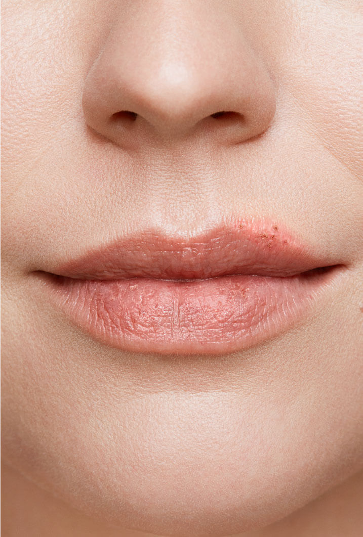 Kvindelige læber med et begyndende forkølelsessår 