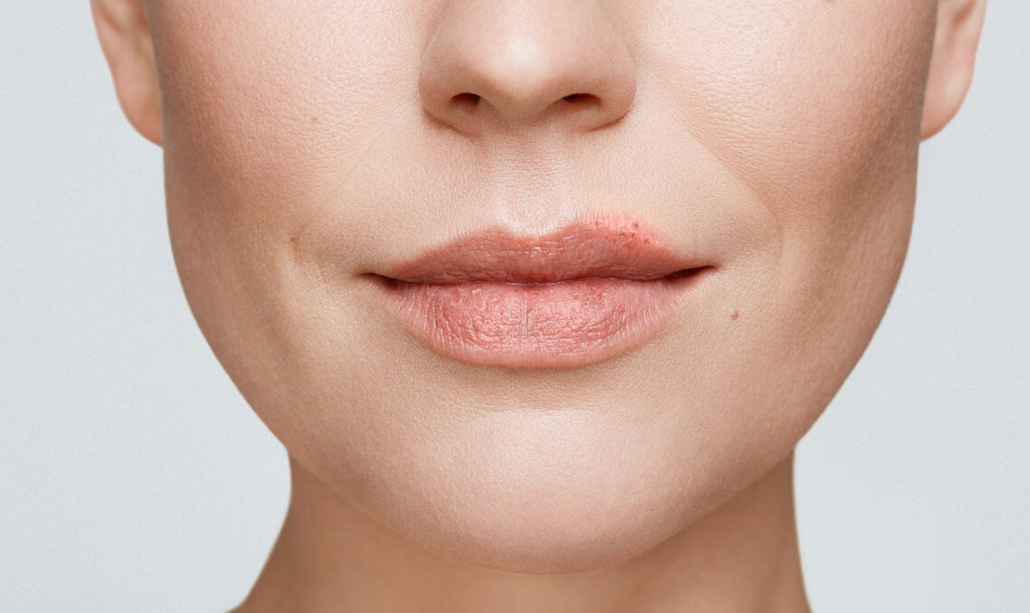 Kvindelige læber med et begyndende forkølelsessår 